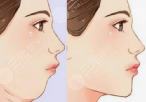 輪廓固定打什么針效果好一點