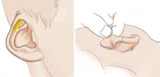 耳朵整形
