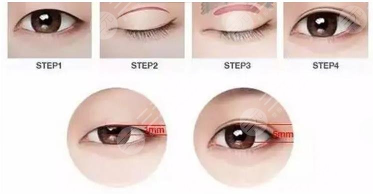 澄海南方醫(yī)院割雙眼皮多少錢