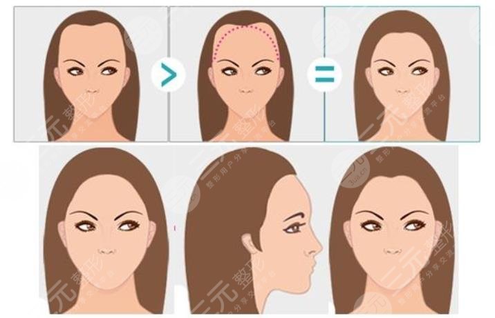 上海中山醫(yī)院植發(fā)多少錢(qián)