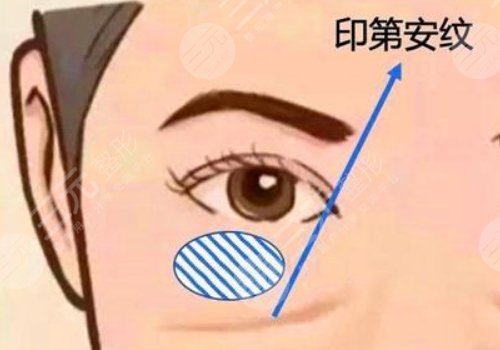 印第安紋和淚溝的區(qū)別是什么？