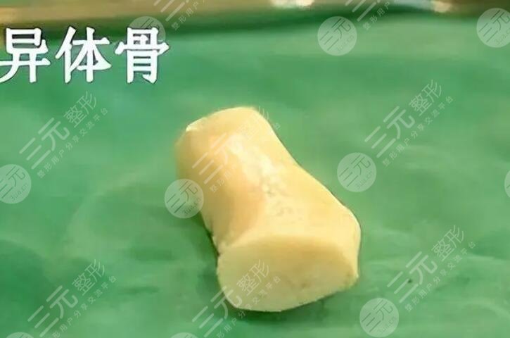 膨體異體骨鼻綜合