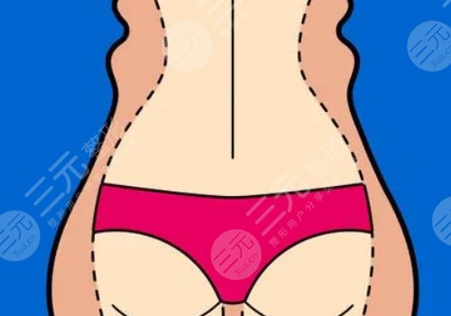 腰腹環(huán)吸大概多少錢