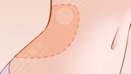 腰腹環(huán)吸包括哪幾個(gè)部位？