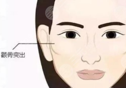 顴骨高怎么改良臉型？