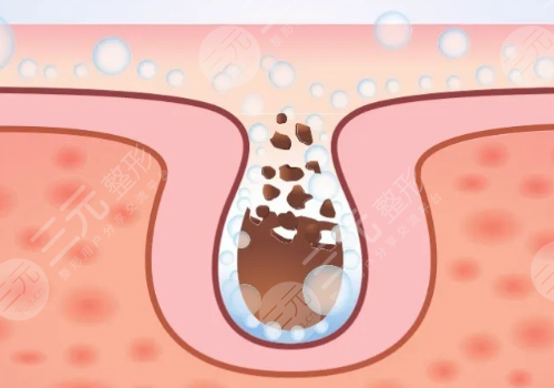 面頰毛孔粗大怎么辦？