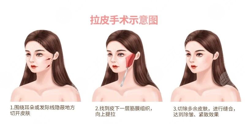 魏廣運(yùn)醫(yī)生拉皮手術(shù)案例