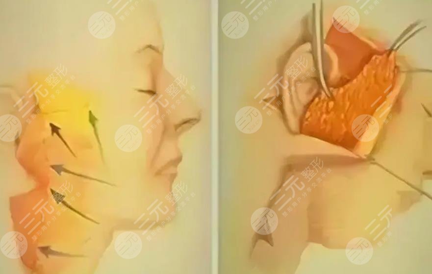 李曉東拉皮手術(shù)案例