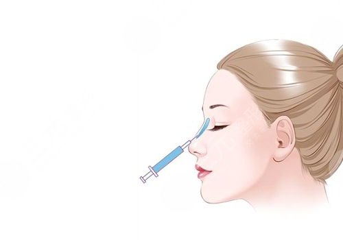 濡白天使隆鼻維持多久？