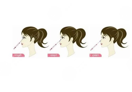 濡白天使隆鼻維持多久？