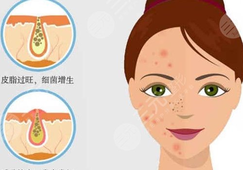 t區(qū)反復(fù)長痘痘的原因是什么？