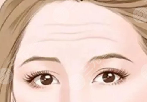 抬頭紋去除手術(shù)需要多少錢？