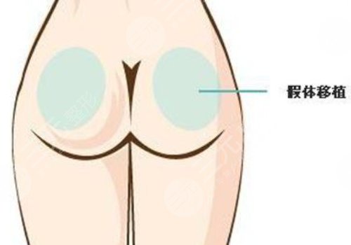 假體豐臀需要多少錢(qián)？