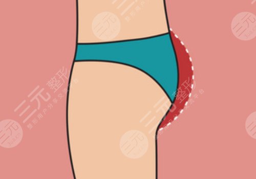 假體豐臀需要多少錢(qián)？