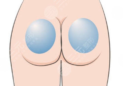 假體豐臀需要多少錢(qián)？