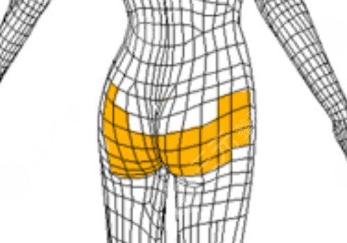 假體豐臀需要多少錢(qián)？