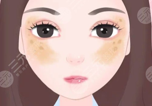 臉頰兩側(cè)長斑是什么原因？