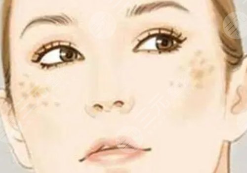 臉頰兩側(cè)長斑是什么原因？