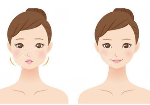 內(nèi)輪廓固定提升能保持多久時(shí)間？