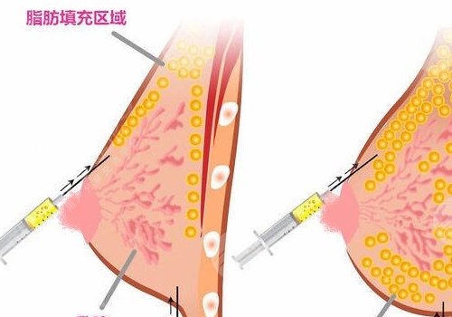 胸型不好看可以調整嗎？