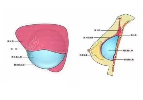 胸型不好看可以調整嗎？