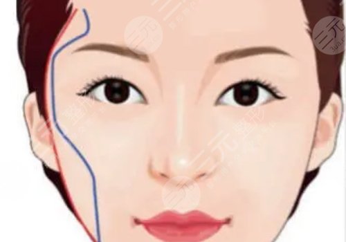 顴弓吸脂有什么后遺癥？