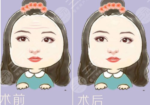 抬頭紋怎么去除？