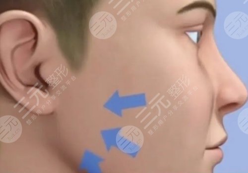 外輪廓固定提升有哪些手術(shù)方案？