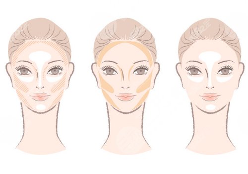 外輪廓固定提升有哪些手術(shù)方案？