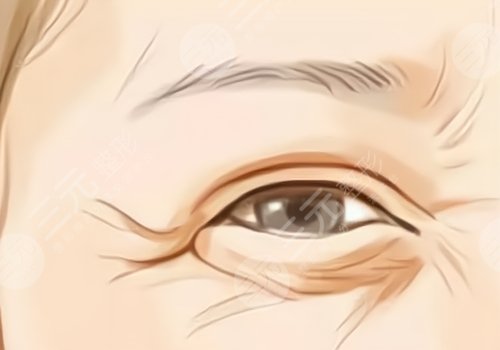 薇旖美可以注射眼部周圍的皺紋不？