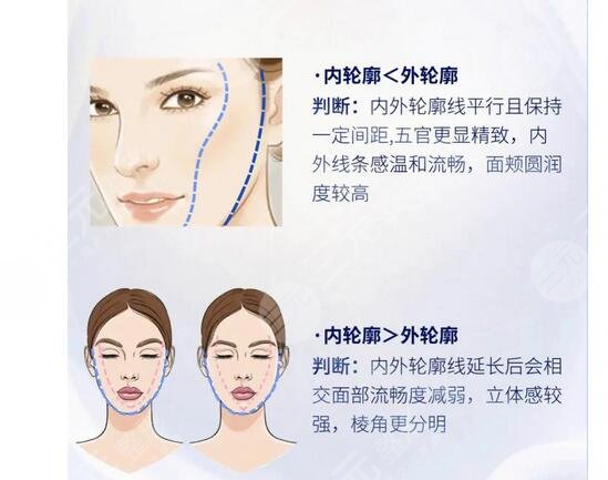 臉部輪廓固定能維持多久？