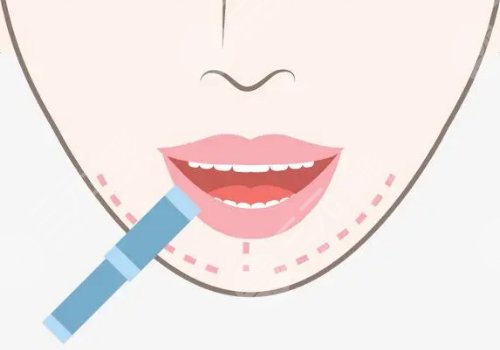 下巴后縮矯正多少錢