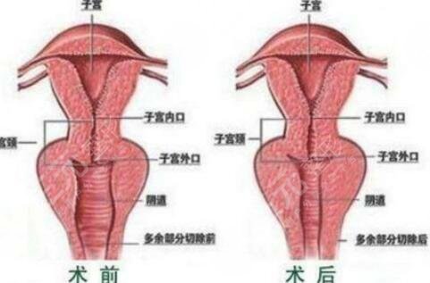 李薇  私密整形會不會有后遺癥