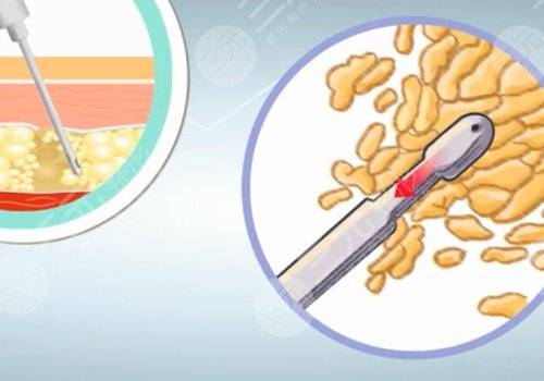 浙江大學醫(yī)學院附屬第一醫(yī)院整形外科技術(shù)怎么樣？