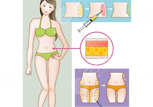 人魚體雕和普通吸脂區(qū)別