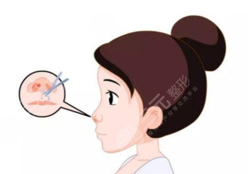 翹鼻和直鼻哪個好看