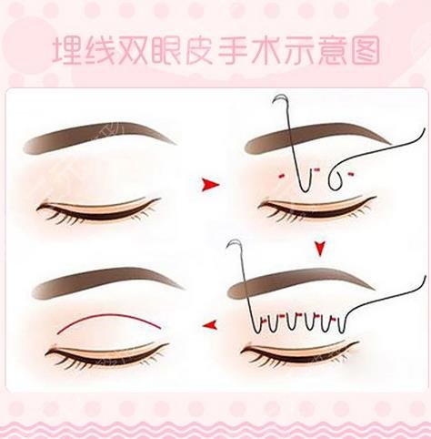 上海第十人民醫(yī)院整形科雙眼皮案例