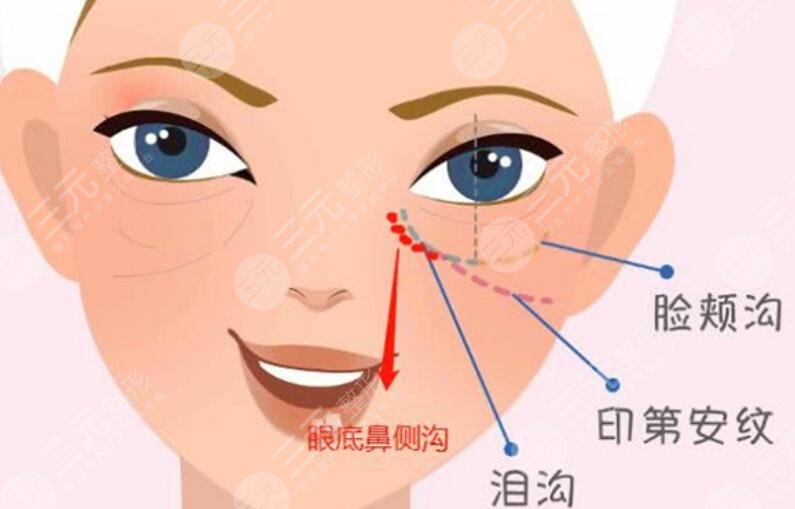 印第安紋填充膠原蛋白