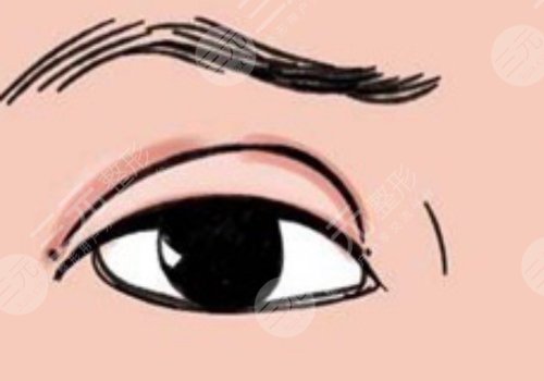 割雙眼皮需要多少錢一次