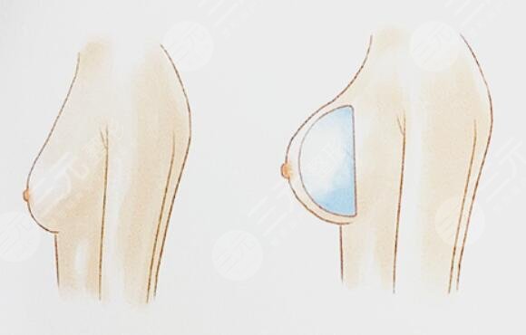 德美假體效果怎么樣？