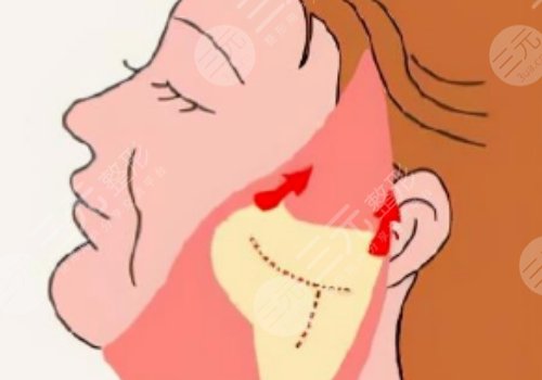 威海拉皮美容要多少錢