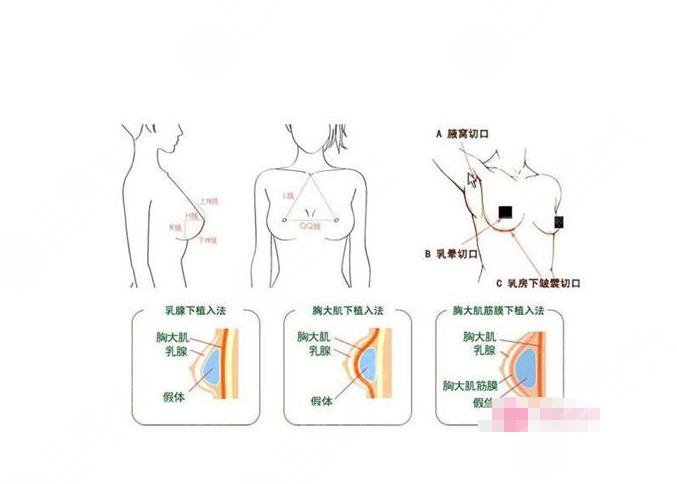 中山一院整形外科乳房再造多少錢(qián)