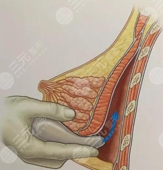 英捷爾法勒隆胸注意事項(xiàng)