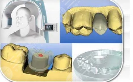德國親骨種植系統(tǒng)