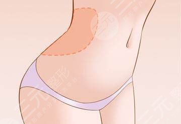 剖腹產(chǎn)疤痕修復(fù)