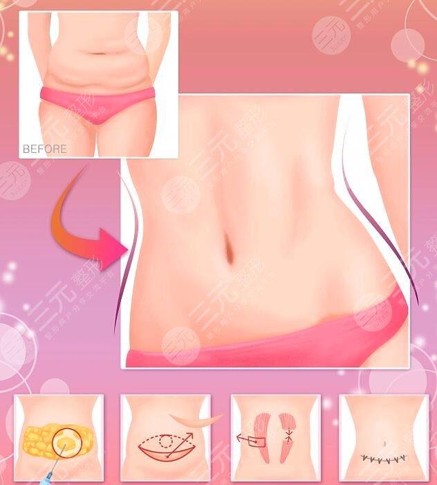 全身抽脂可以保持多久？