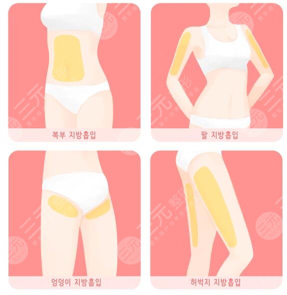 全身抽脂可以保持多久？