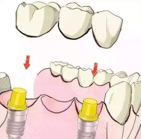 上海九醫(yī)院種植牙案例