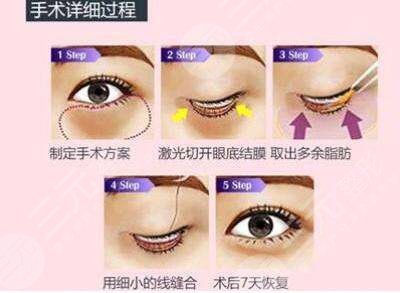 哈爾濱雅美整形醫(yī)療美容醫(yī)院價格表更新！去眼袋術后點評，避坑！