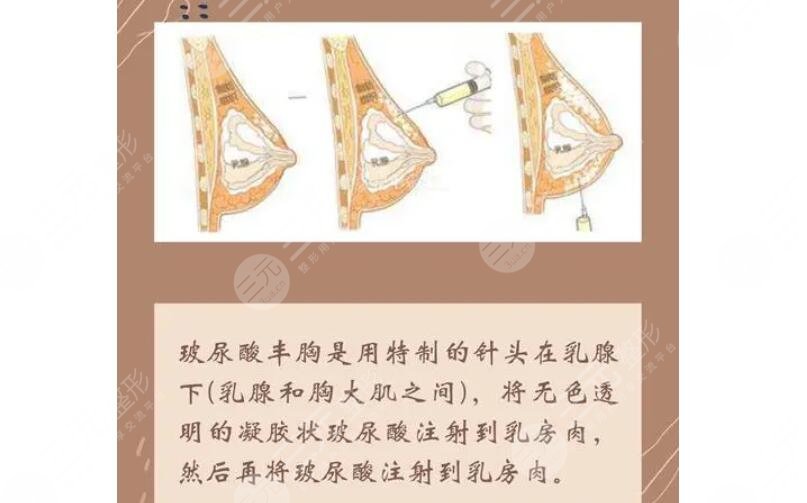 北京韓興斌隆胸怎么樣?